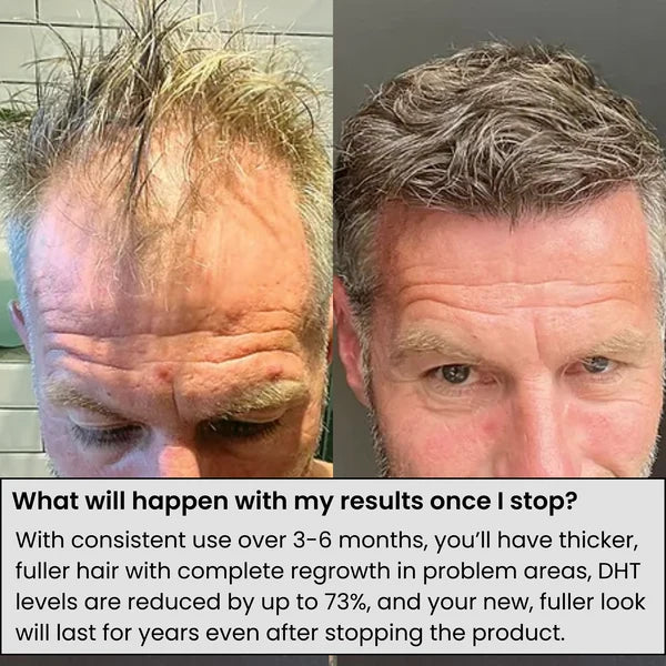 Hair Regrowth System